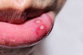 stomatit stamatit ağız yarası dil